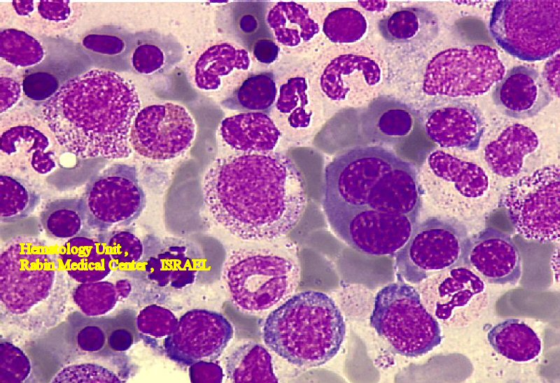 MDS - Tri Nuclear Erythroblast (BM)