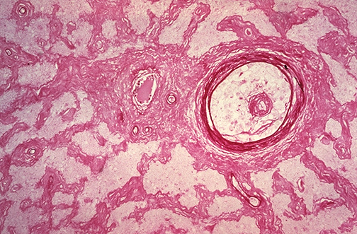 Ophthalmic Pathology Ophthalmic Pathology