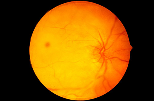 Cherry-Red Spot in Tay–Sachs Disease