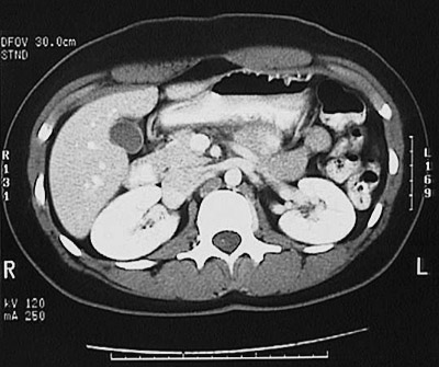 Abdominal CT Scan Anatomy