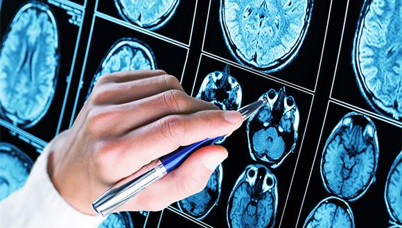 פתרון החידה המדעית שיעניק תקווה לחולי אפילפסיה
