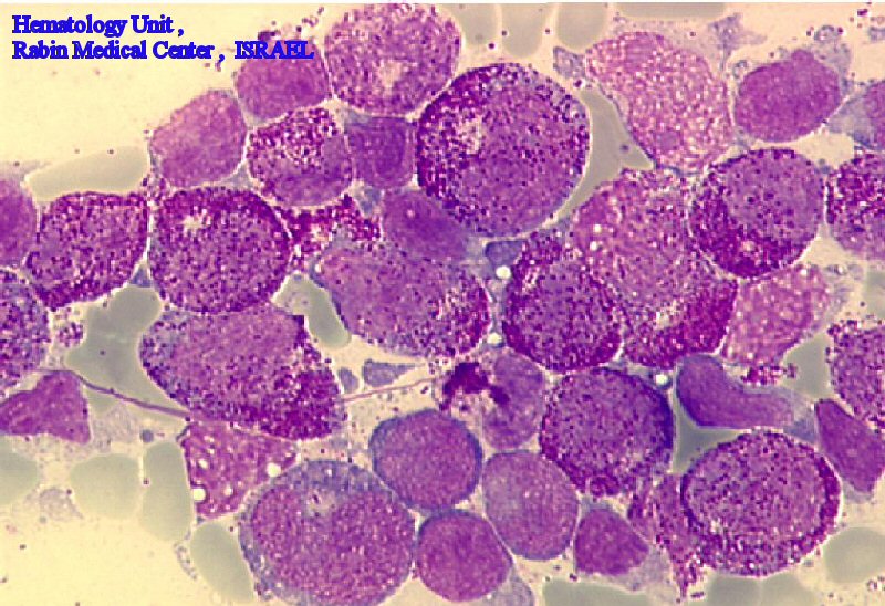 AML(m3) (BM)