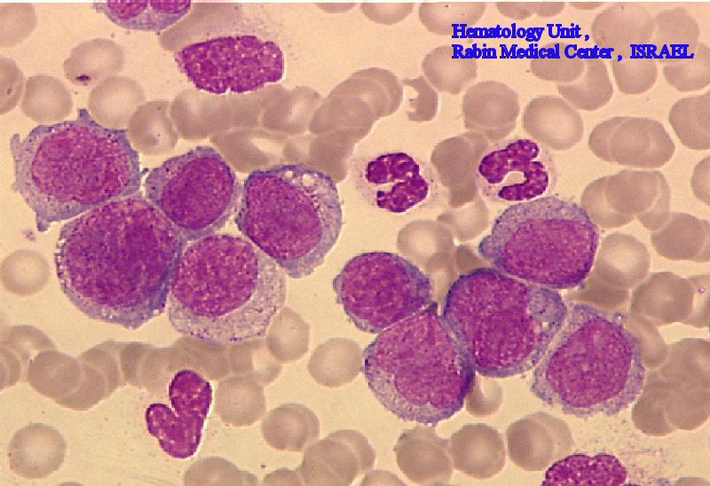AML(m5) (PB)