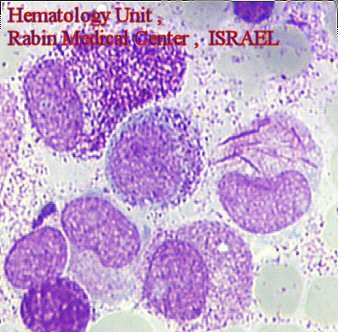 AML (M3)