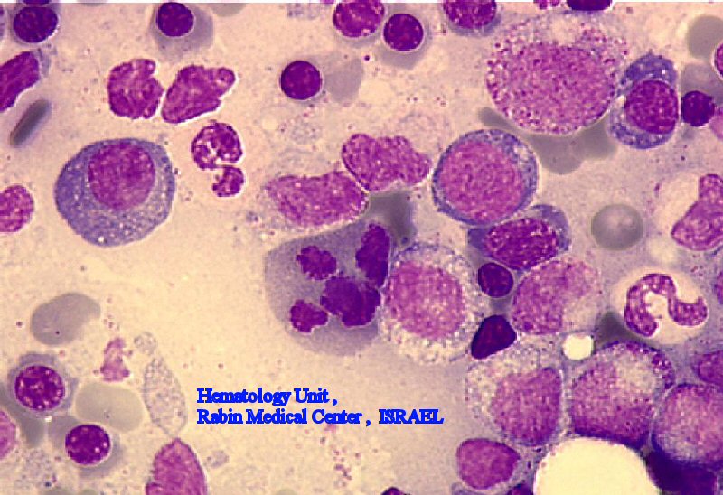 MDS - Dyserythropoiesis (BM)