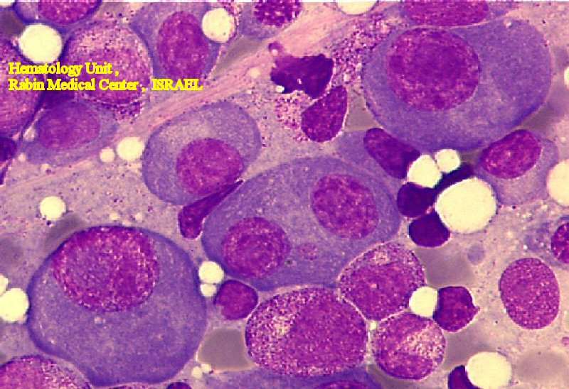 Multiple Myeloma (BM)