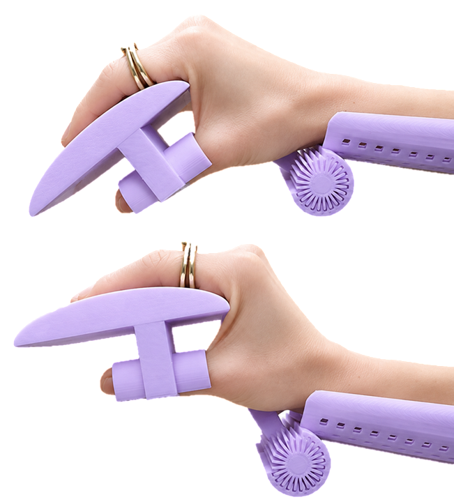 3D-printed static progressive splint for burn contracture management, fitted on a hand