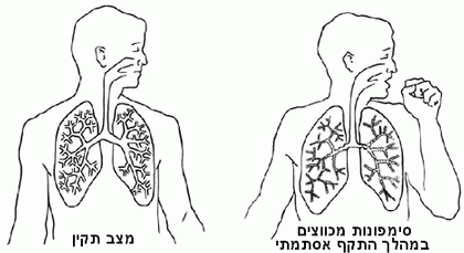 אסתמה